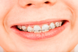 braces_dentistry_stomatology_h